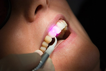 Laserbehandlung